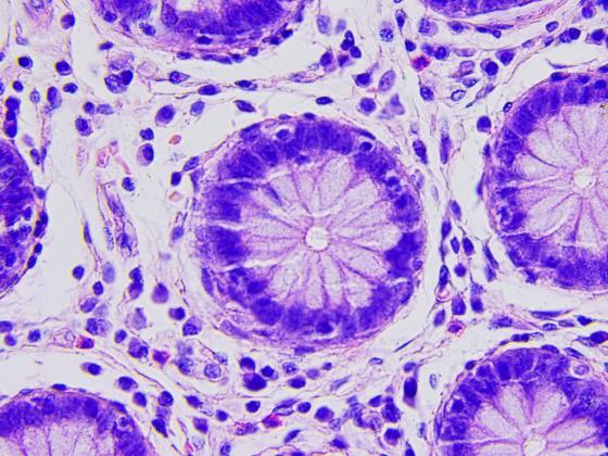 Colon cancer cells under a microscope.